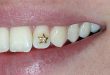 Tooth jewellery | Teeth jewel