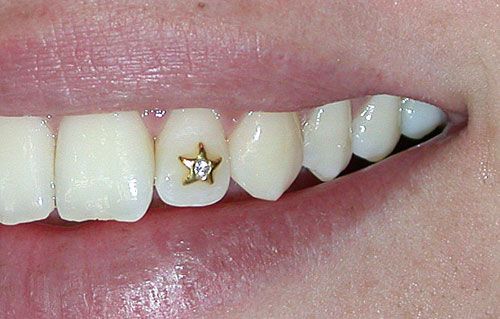 Tooth jewelery